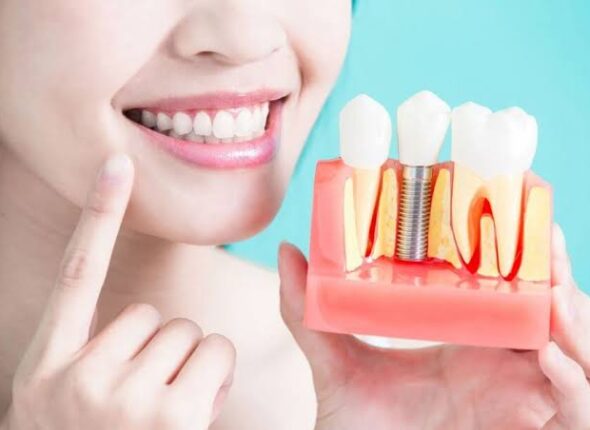 dental-implants