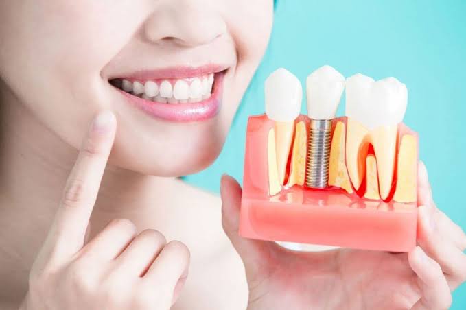 dental-implants